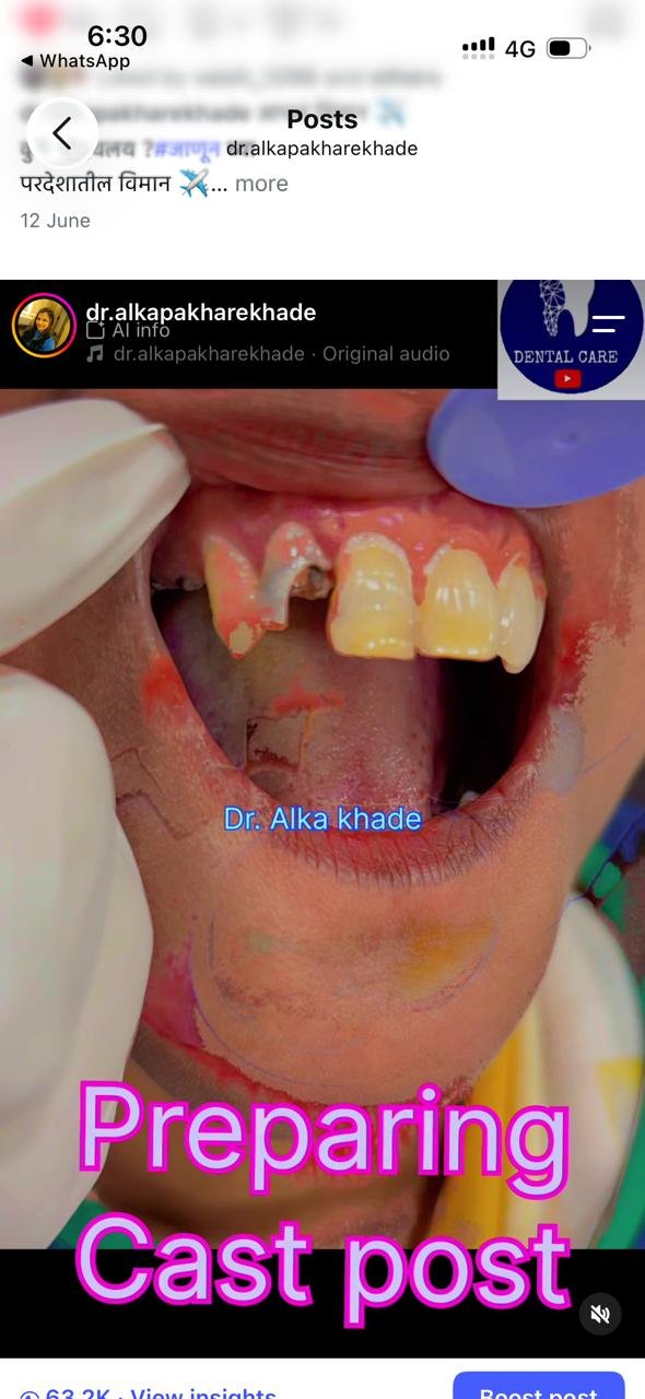 Broken upper front teeth before cast post treatment