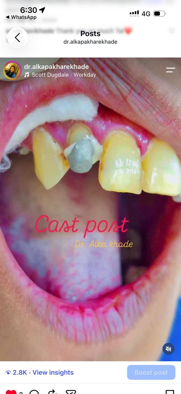 Cast post fitted into the tooth