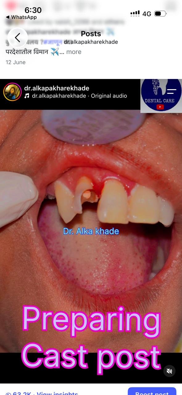 Close-up of tooth stump during cast post preparation